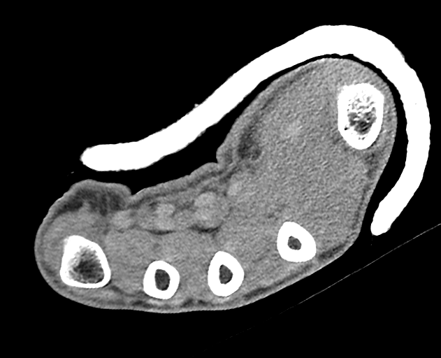 Normal wrist CT (Radiopaedia 41425-44297 Axial non-contrast 13).png