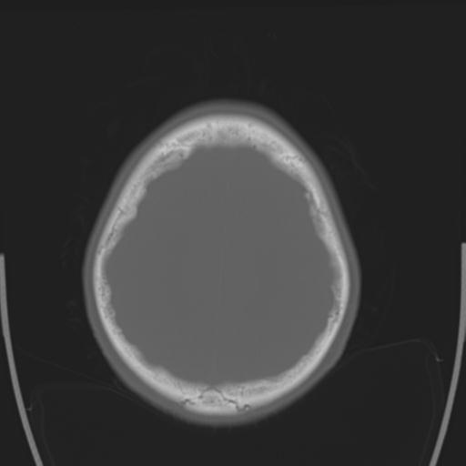 File:Obstructive hydrocephalus (Radiopaedia 30453-31119 Axial bone window 7).jpg