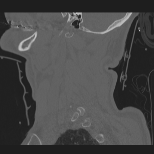 File:Occipital condyle fracture (Radiopaedia 33467-34517 Sagittal bone window 11).png