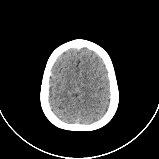Occipital encephalocele (Radiopaedia 87339-103636 Axial non-contrast 69).jpg