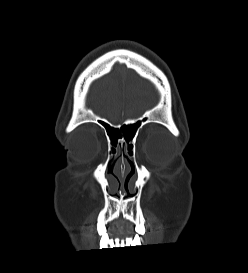 Occipital spur and Currarino type A atlas anomaly (Radiopaedia 87027-103285 Coronal bone window 33).jpg
