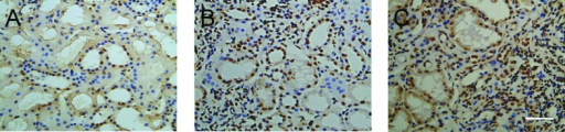 a) Apoptotic cell death in IgA nephropathy b,c) scattered distribution in IgA nephropathy.