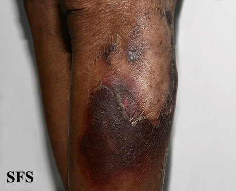 File:Pellagra (Dermatology Atlas 54).jpg
