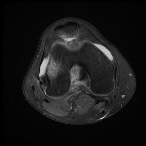 File:ACL acute full thickness tear - deep lateral femoral sulcus sign (Radiopaedia 38594-40740 Axial PD fat sat 14).jpg