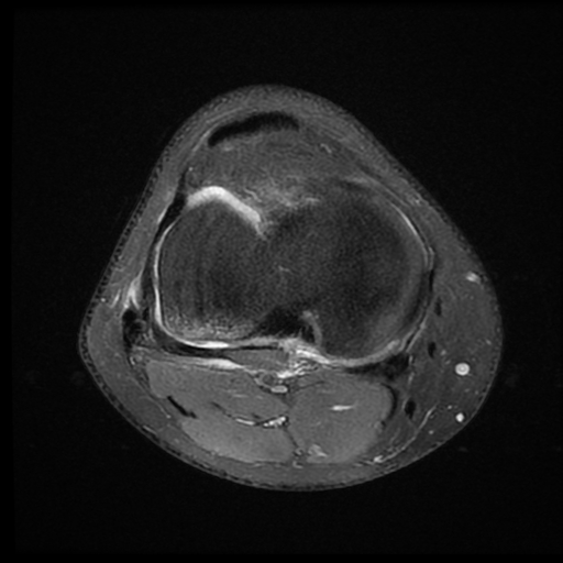 File:ACL acute full thickness tear - deep lateral femoral sulcus sign (Radiopaedia 38594-40740 Axial PD fat sat 18).jpg