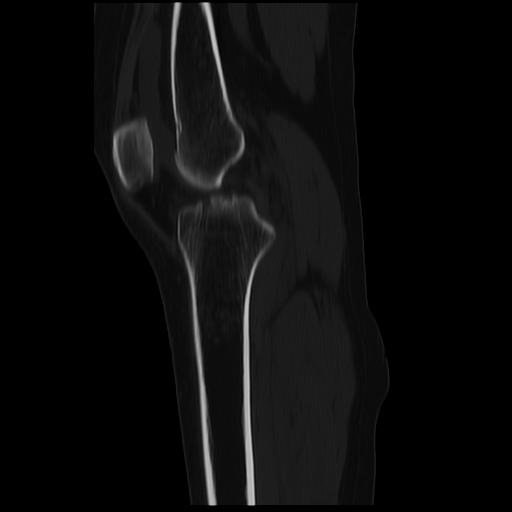 File:ACL avulsion fracture (Radiopaedia 33833-34994 Sagittal bone window 25).jpg