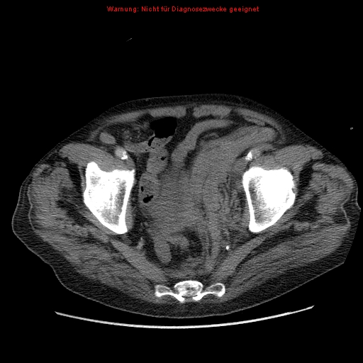 Abdominal aortic aneurysm- extremely large, ruptured (Radiopaedia 19882-19921 Axial C+ arterial phase 69).jpg