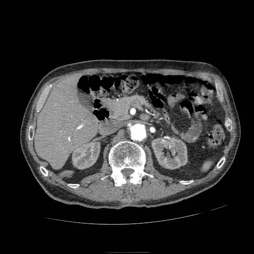 Abdominal aortic aneurysm (Radiopaedia 13341-13340 Axial C+ arterial phase 64).jpg