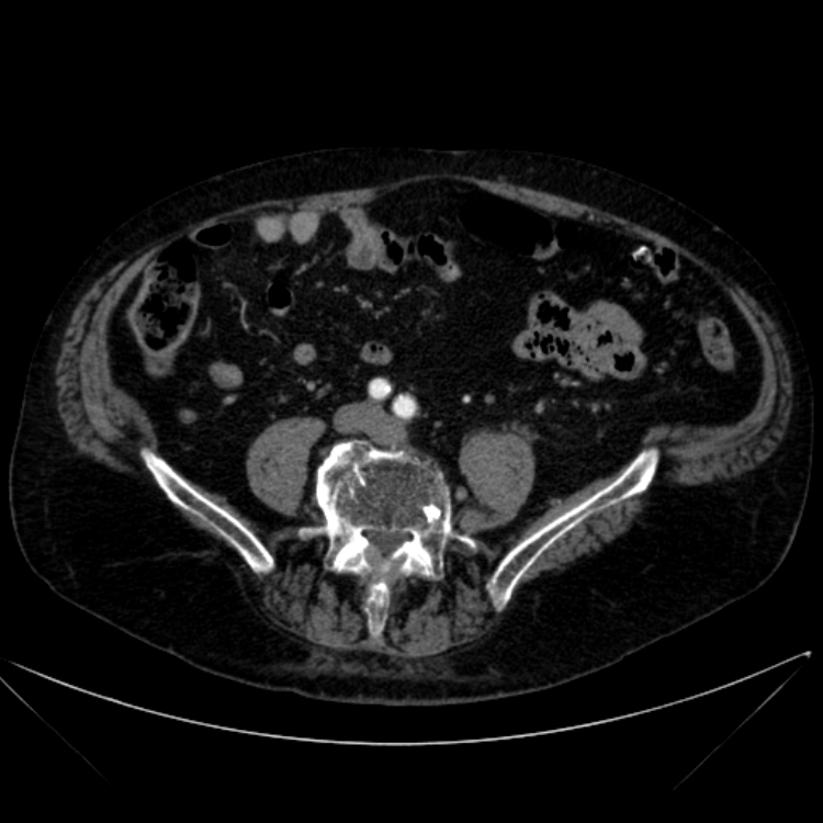 Abdominal aortic aneurysm (Radiopaedia 25855-26001 Axial C+ arterial phase 89).jpg