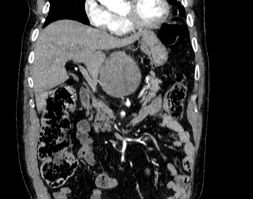 Abdominal aortic aneurysm (Radiopaedia 67117-76452 Coronal C+ arterial phase 26).jpg