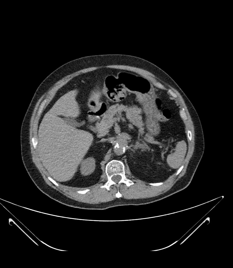 Abdominal aortic aneurysm with thrombus fissuration (Radiopaedia 46218-50618 Axial non-contrast 15).jpg
