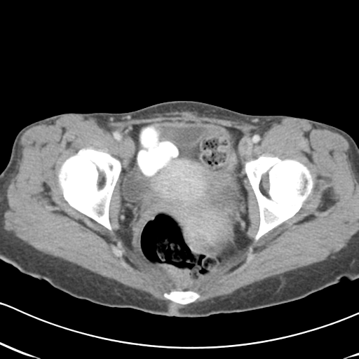 Abdominal desmoid tumor (Radiopaedia 41007-43740 Axial C+ portal venous phase 67).png