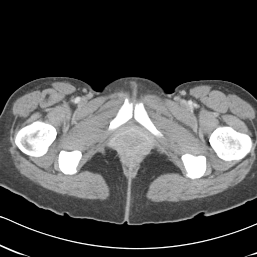 Abdominal desmoid tumor (Radiopaedia 41007-43740 Axial C+ portal venous phase 77).png