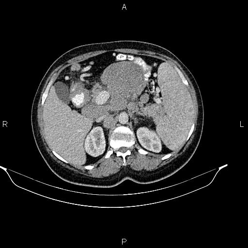 Abdominal lymphoma with sandwich sign (Radiopaedia 84378-99704 Axial C+ portal venous phase 19).jpg