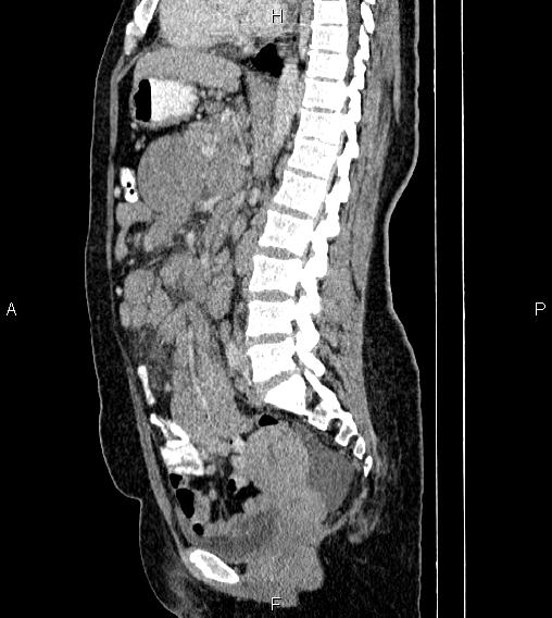 Abdominal lymphoma with sandwich sign (Radiopaedia 84378-99704 Sagittal C+ portal venous phase 44).jpg