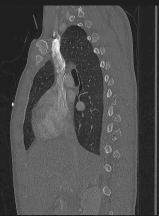 Abdominal multi-trauma - devascularised kidney and liver, spleen and pancreatic lacerations (Radiopaedia 34984-36486 Sagittal bone window 50).png