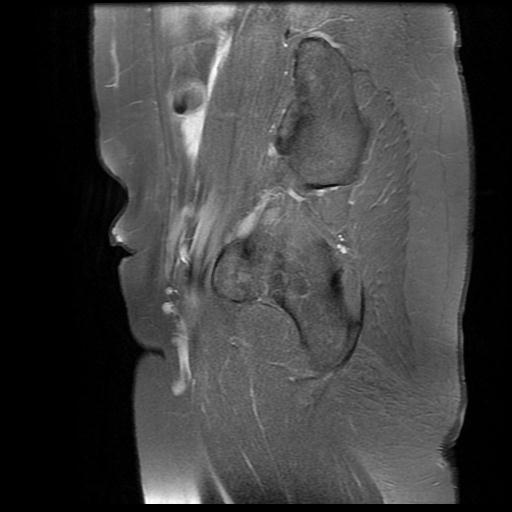 File:Abdominal wall endometriosis (Radiopaedia 83702-98847 Sagittal T1 C+ fat sat 16).jpg