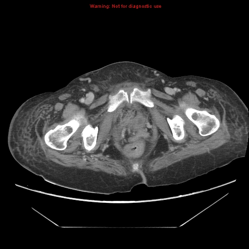 File:Abdominal wall hematoma (Radiopaedia 9427-10112 Axial C+ portal venous phase 107).jpg