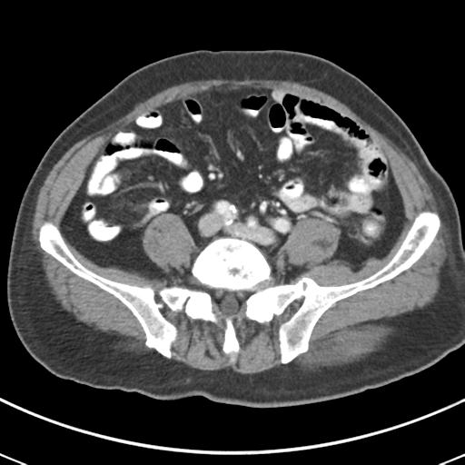 File:Abdominal wall metastasis from colorectal carcinoma (Radiopaedia 31016-31717 Axial C+ portal venous phase 51).jpg