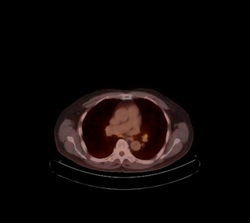 Abdominal wall metastasis from colorectal carcinoma (Radiopaedia 31016-31719 C 108).jpg