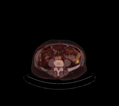File:Abdominal wall metastasis from colorectal carcinoma (Radiopaedia 31016-31719 C 53).jpg