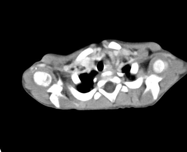 File:Abdominopelvic rhabdomyosarcoma (Radiopaedia 78356-90984 Axial C+ portal venous phase 2).jpg