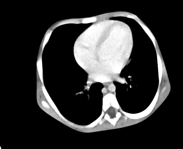 File:Abdominopelvic rhabdomyosarcoma (Radiopaedia 78356-90984 Axial C+ portal venous phase 28).jpg