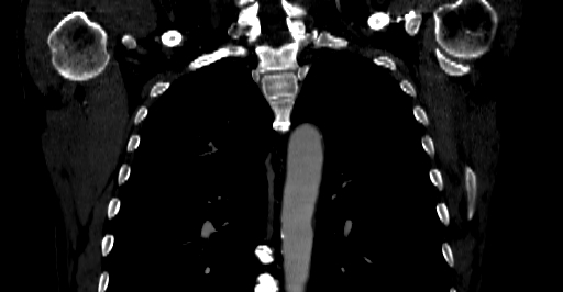 Accesory rib joint (Radiopaedia 71987-82452 Coronal bone window 15).jpg