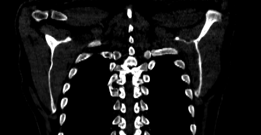 Accesory rib joint (Radiopaedia 71987-82452 Coronal bone window 65).jpg