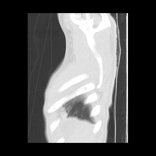 Accessory left horizontal fissure with lingular pneumonia (Radiopaedia 53763-59843 Sagittal lung window 63).jpg