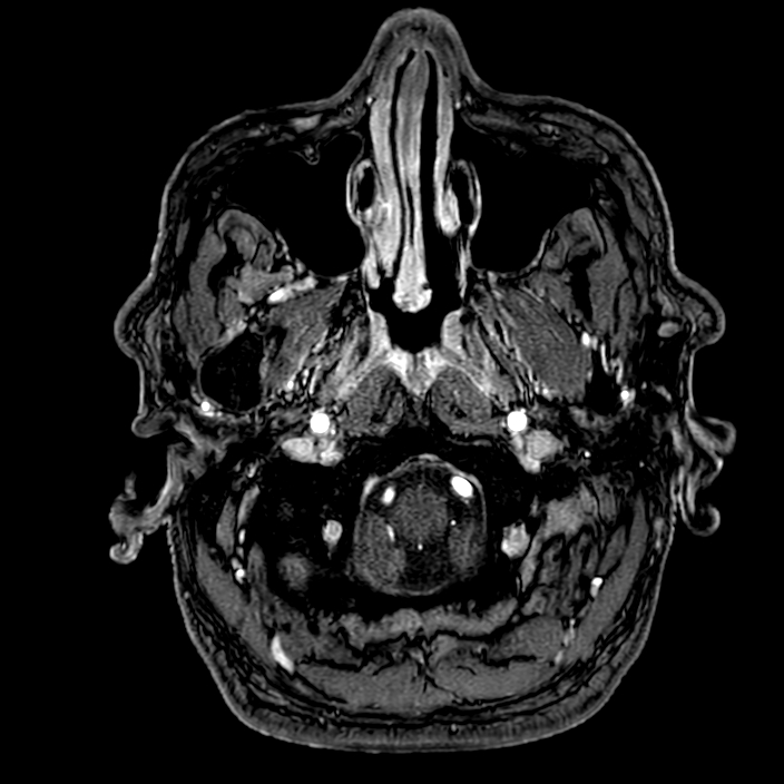 Accessory middle cerebral artery (Radiopaedia 73114-83828 Axial MRA 2).jpg