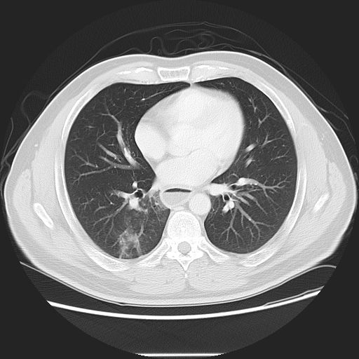 Achalasia (Radiopaedia 8831-9629 Axial lung window 36).jpg