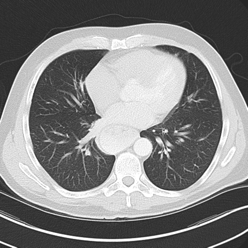 File:Achalasia of the cardia (Radiopaedia 38497-40595 Axial lung window 33).png