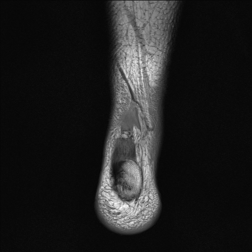 File:Achilles tendon tear (Radiopaedia 77615-89819 Coronal T1 26).jpg