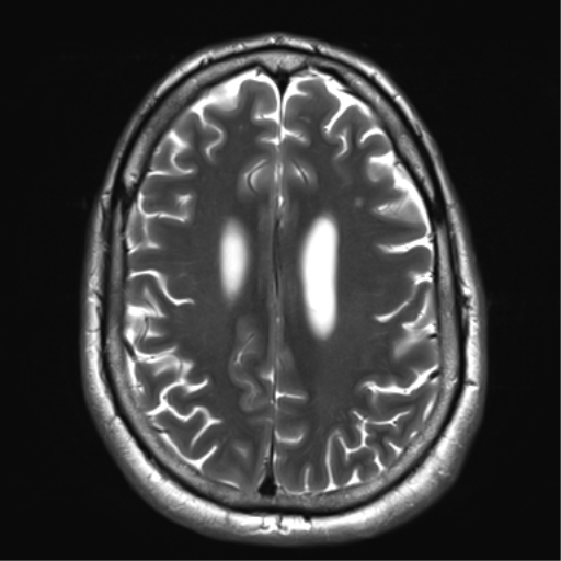 File:Achondroplasia (Radiopaedia 65109-74105 Axial T2 29).png