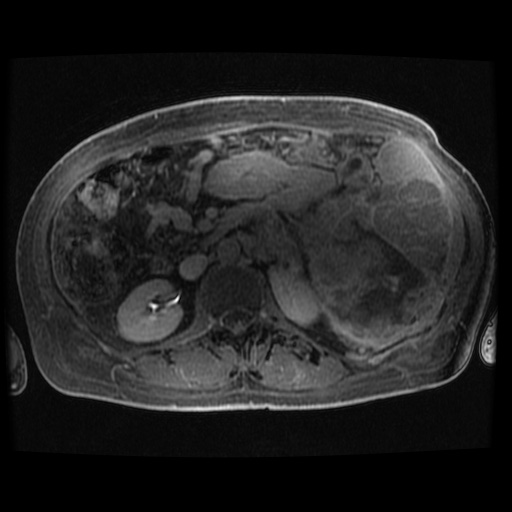 Acinar cell carcinoma of the pancreas (Radiopaedia 75442-86668 Axial late phase (~30 mins) 39).jpg