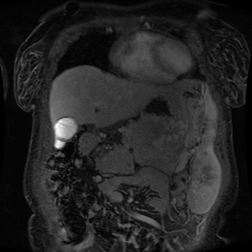 File:Acinar cell carcinoma of the pancreas (Radiopaedia 75442-86668 Coronal T1 C+ fat sat 141).jpg