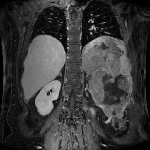 Acinar cell carcinoma of the pancreas (Radiopaedia 75442-86668 Coronal T1 C+ fat sat 58).jpg