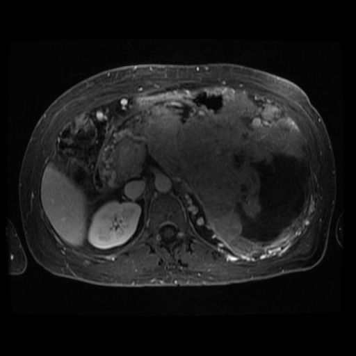 Acinar cell carcinoma of the pancreas (Radiopaedia 75442-86668 D 61).jpg