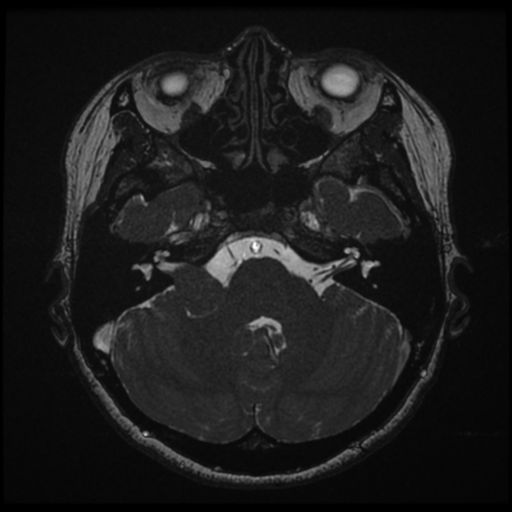 File:Acoustic neuroma (Radiopaedia 34049-35283 Axial 52).png
