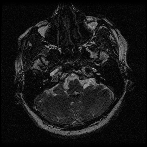 Acoustic schwannoma (Radiopaedia 33045-34060 Axial T2 12).png