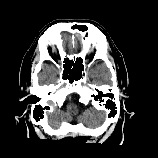 File:Acoustic schwannoma (Radiopaedia 55729-62280 Axial non-contrast 8).png