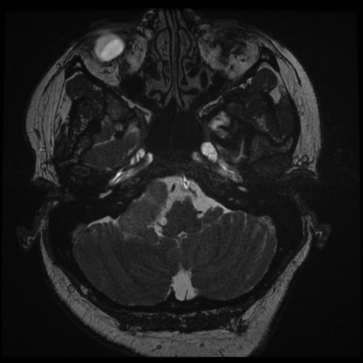 Acoustic schwannoma (Radiopaedia 57574-64536 Axial T2 16).png