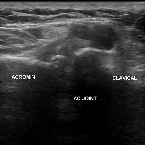 File:Acromioclavicular joint arthrosis with periarticular cyst (Radiopaedia 12893-13010 B 1).jpg