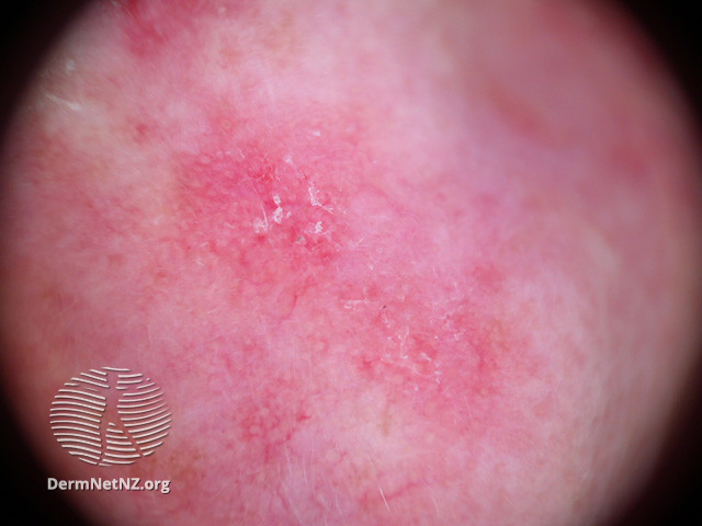 Actinic Keratoses affecting the face (DermNet NZ lesions-ak-face-490).jpg