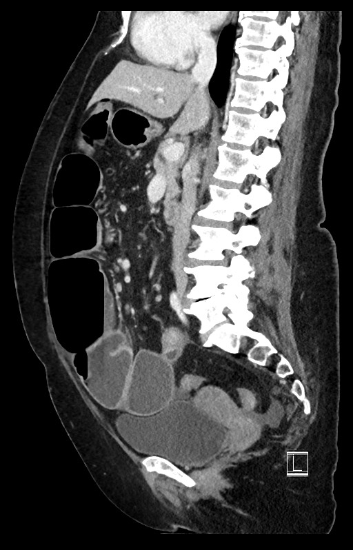 Active Crohn disease (Radiopaedia 59394-66750 Sagittal C+ portal venous phase 31).jpg
