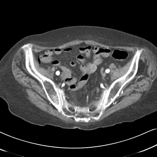 Active bleeding from duodenal ulcer with embolization (Radiopaedia 34216-35481 Axial C+ arterial phase 51).png