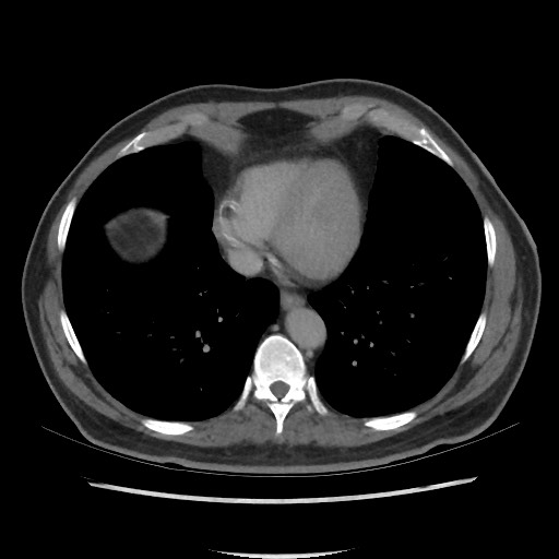 File:Active colonic bleed on CT (Radiopaedia 49765-55025 Axial C+ delayed 5).jpg