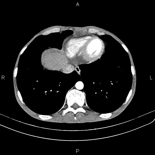 Active crohn disease (Radiopaedia 87133-103397 Axial C+ arterial phase 10).jpg