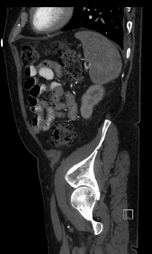 Active lower gastrointestinal bleeding - diverticular (Radiopaedia 61203-69106 Sagittal C+ arterial phase 33).jpg